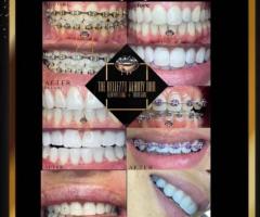 Tooth Gems & Teeth Whitening